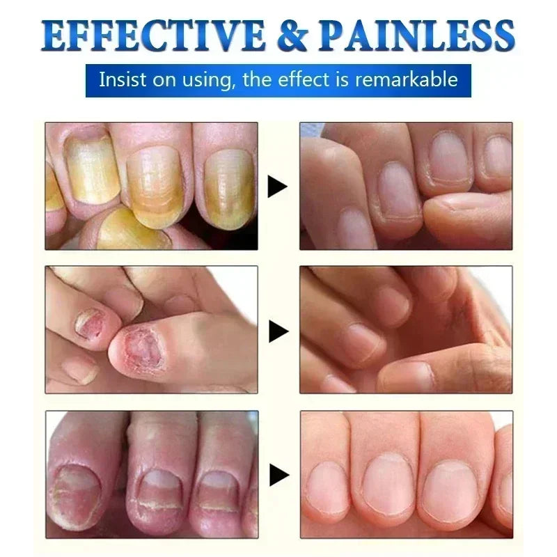 Electric Toenail Fungus Treatment Device Nail Care