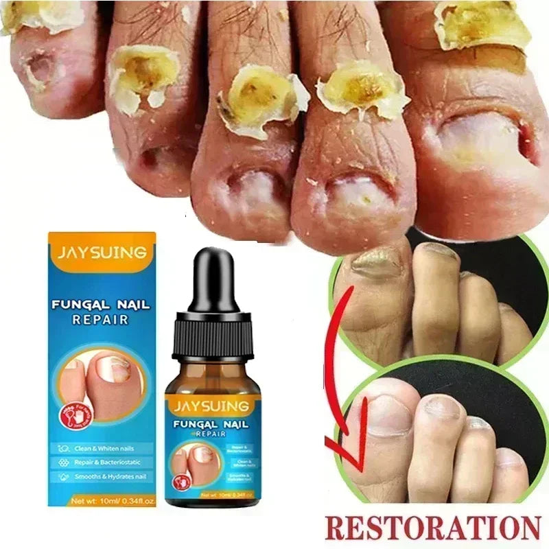 Electric Toenail Fungus Treatment Device Nail Care